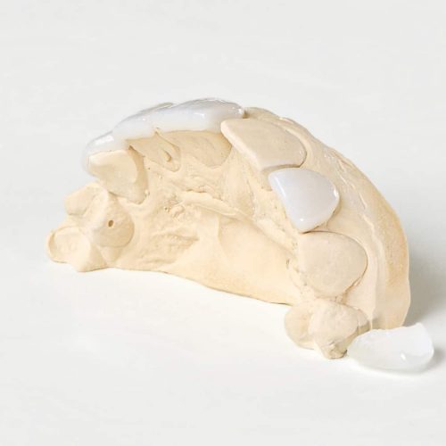 Licowki-porcelanowe-p7ngsh4oi476c9kwdpeozsav9mcllprrukw0u1nclk